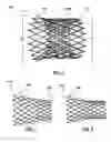 Fig. 03 - Segmented transcatheter valve prosthesis having an unsupported valve segment