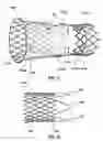 Fig. 07 - Segmented transcatheter valve prosthesis having an unsupported valve segment