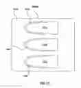 Fig. 08 - Segmented transcatheter valve prosthesis having an unsupported valve segment