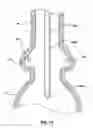 Fig. 09 - Segmented transcatheter valve prosthesis having an unsupported valve segment