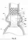 Fig. 13 - Segmented transcatheter valve prosthesis having an unsupported valve segment