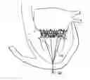 Fig. 01 - Truncated cone heart valve stent