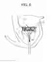 Fig. 06 - Truncated cone heart valve stent