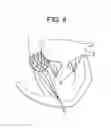 Fig. 09 - Truncated cone heart valve stent