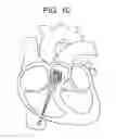 Fig. 10 - Truncated cone heart valve stent