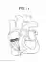 Fig. 11 - Truncated cone heart valve stent