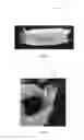Fig. 05 - Fenestrated bone graft