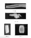 Fig. 07 - Tasseled bone graft