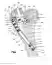 Fig. 04 - Implants/procedures related to tibial tuberosity advancement