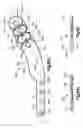 Fig. 17 - Implants/procedures related to tibial tuberosity advancement