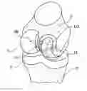 Fig. 01 - Knee prosthesis