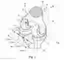 Fig. 02 - Knee prosthesis