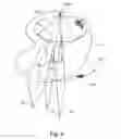 Fig. 05 - Knee prosthesis