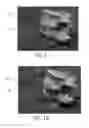 Fig. 12 - Intervertebral cage for spinal implant