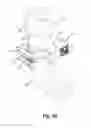 Fig. 03 - CONTROLLED CORONAL STIFFNESS PROSTHETIC ANKLE