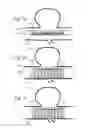 Fig. 09 - Stent with outer member to embolize an aneurysm