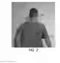 Fig. 03 - Treatment of spinal deformities