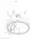 Fig. 05 - Method and apparatus for penis enlargement