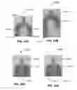 Fig. 25 - System and Method for Treating Skin and Underlying Tissues for Improved Health, Function and/or Appearance