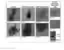 Fig. 14 - Methods, compositions, and kits for improving pancreatic beta cell viability and treating diseases or conditions related to beta cell destruction