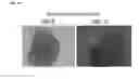 Fig. 16 - Methods, compositions, and kits for improving pancreatic beta cell viability and treating diseases or conditions related to beta cell destruction