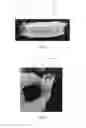 Fig. 05 - Fenestrated bone wrap graft
