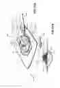 Fig. 51 - Apparatuses and methods for negative pressure wound therapy
