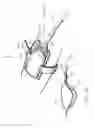 Fig. 79 - Apparatuses and methods for negative pressure wound therapy