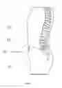 Fig. 03 - Intrathecal baclofen pharmaceutical dosage forms and related delivery system