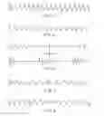 Fig. 04 - System and method for diagnosis and treatment of a breathing pattern of a patient