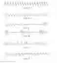 Fig. 04 - System and method for diagnosis and treatment of a breathing pattern of a patient