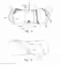 Fig. 03 - Double Notched Catheter Securement Device