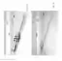 Fig. 07 - Self-anchoring catheters and methods of use