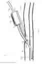 Fig. 02 - System for anchoring medical devices
