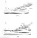 Fig. 08 - System for anchoring medical devices