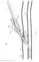 Fig. 15 - System for anchoring medical devices