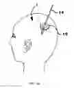 Fig. 07 - Methods and device to neutralize soluble toxic agents in the brain