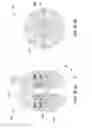 Fig. 15 - Method of forming lateral boreholes from a parent wellbore