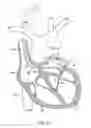 Fig. 10 - Systems and methods for unobstructed visualization and ablation