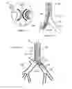 Fig. 02 - ENDOBRONCHIAL TUBE WITH INTEGRATED IMAGE SENSOR