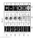Fig. 18 - QUANTIFICATION OF LOCAL CIRCULATION WITH OCT ANGIOGRAPHY