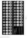 Fig. 13 - Magnetoencephalography source imaging for neurological functionality characterizations