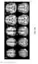 Fig. 17 - Magnetoencephalography source imaging for neurological functionality characterizations