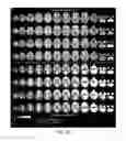 Fig. 20 - Magnetoencephalography source imaging for neurological functionality characterizations