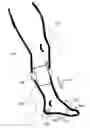 Fig. 01 - Neuropathic Assistive Device