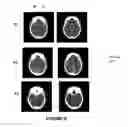 Fig. 11 - Systems and methods for diagnosing strokes
