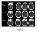 Fig. 13 - Systems and methods for diagnosing strokes