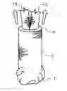 Fig. 01 - SOCK ANCHOR AND METHOD