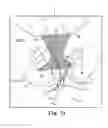 Fig. 72 - Tissue anchor system
