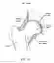Fig. 07 - Method and apparatus for attaching tissue to bone, including the provision and use of a novel knotless suture anchor system